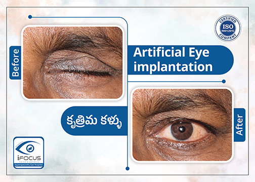Artificial eye implantation prosthesis before and after results