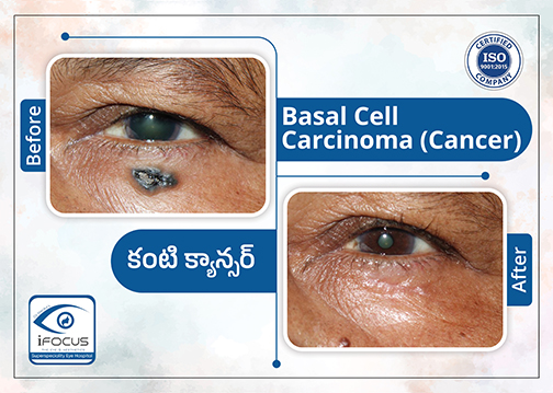 Basal Cell Carcinoma eyelid reconstruction before and after treatment