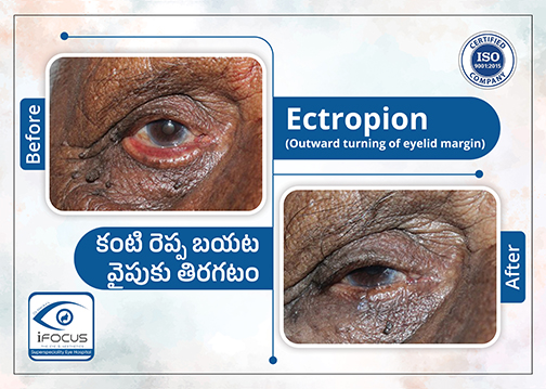Ectropion correction surgery before and after results