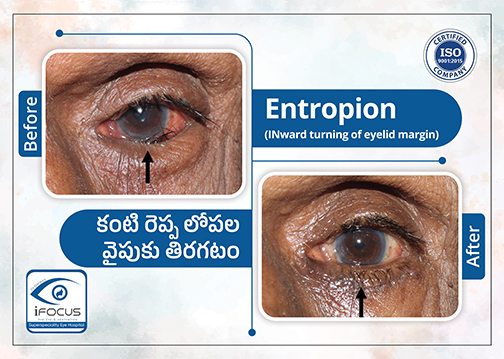 Entropion eyelid correction before and after treatment