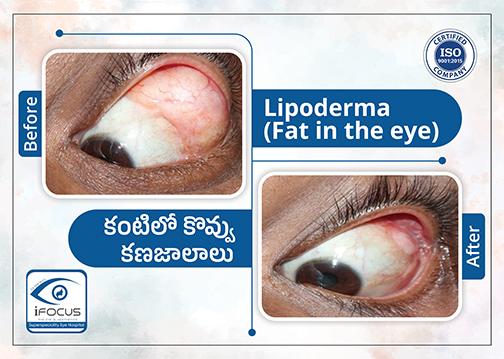 Before and after Lipoderma treatment case study