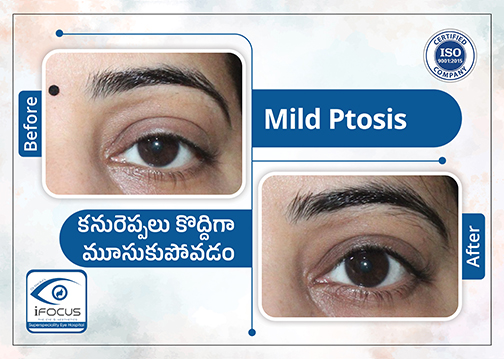 Mild ptosis eyelid surgery before and after results