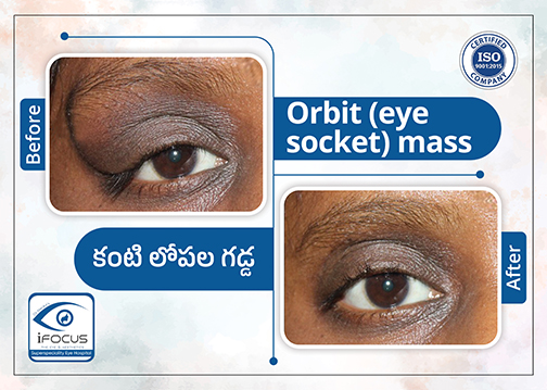 Orbital mass removal surgery before and after case study