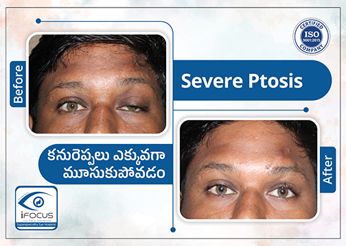 Severe ptosis correction surgery before and after results