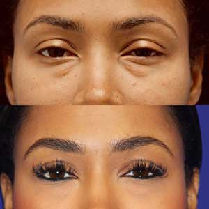 Blepharoplasty in Vijayawada