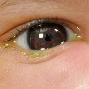 Congenital lacrimal duct block management in Vijayawada