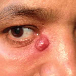 DCT Treatment in Vijayawada