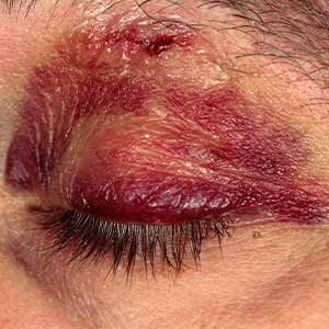 Eyelid laceration repair in Vijayawada