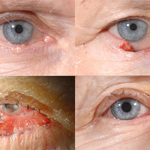 Eyelid swellings , Eyelid Tumor removal & eyelid reconstruction