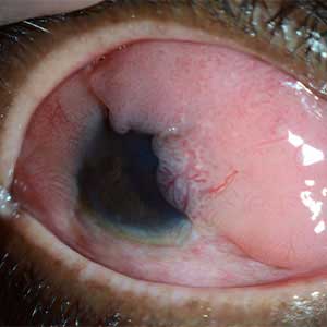 Ocular surface tumours Treatment in Vijayawada