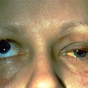 Orbital fracture repair in vijayawada