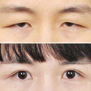 Ptosis correction in Vijayawada