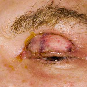 Skin grafting in Vijayawada